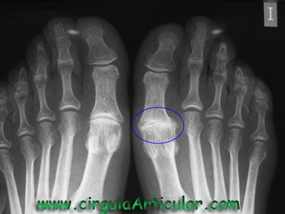 hallux rigidus