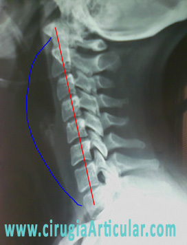 contractura cervical