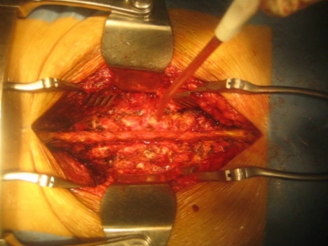 Estenosis lumbar