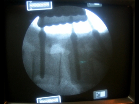 Estenosis lumbar