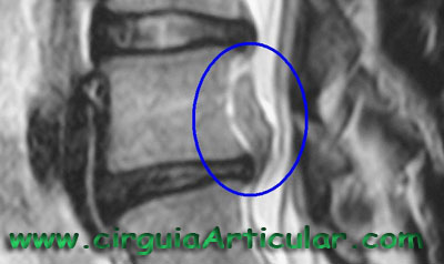 hernia discal lumbar