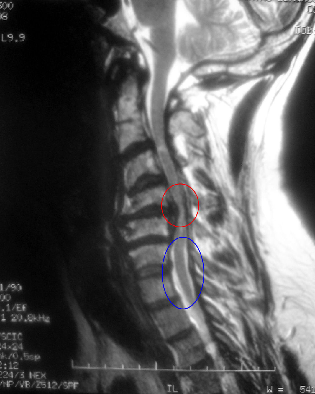 mielopatia cervical