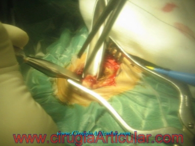 artrodesis subastragalina o fusion de articulaciones del pie