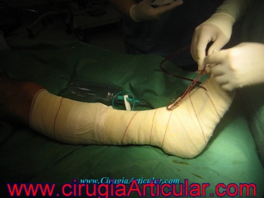 artrodesis subastragalina o fusion de articulaciones del pie