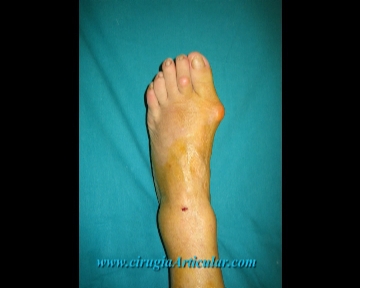 cirugia arbierta de hallux valgus