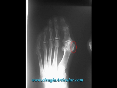 cirugia arbierta de hallux valgus