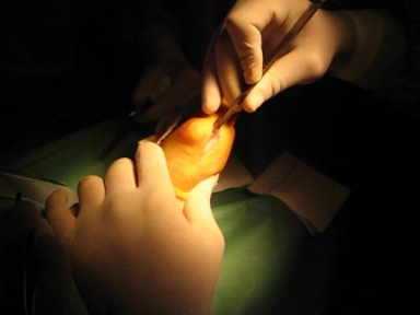 cirugia arbierta de hallux valgus