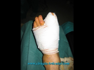 cirugia arbierta de hallux valgus