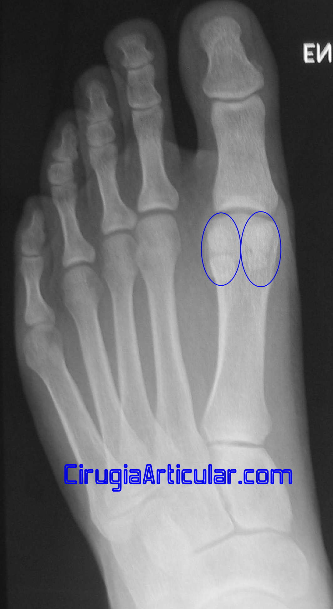 Sesamoiditis