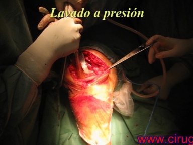 protesis de rodilla