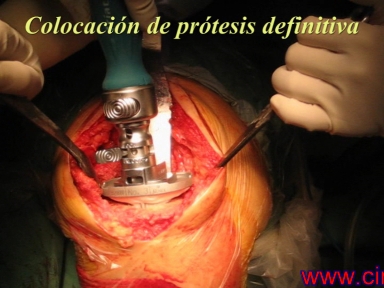 protesis de rodilla