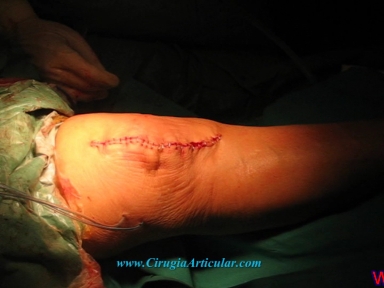 protesis de rodilla